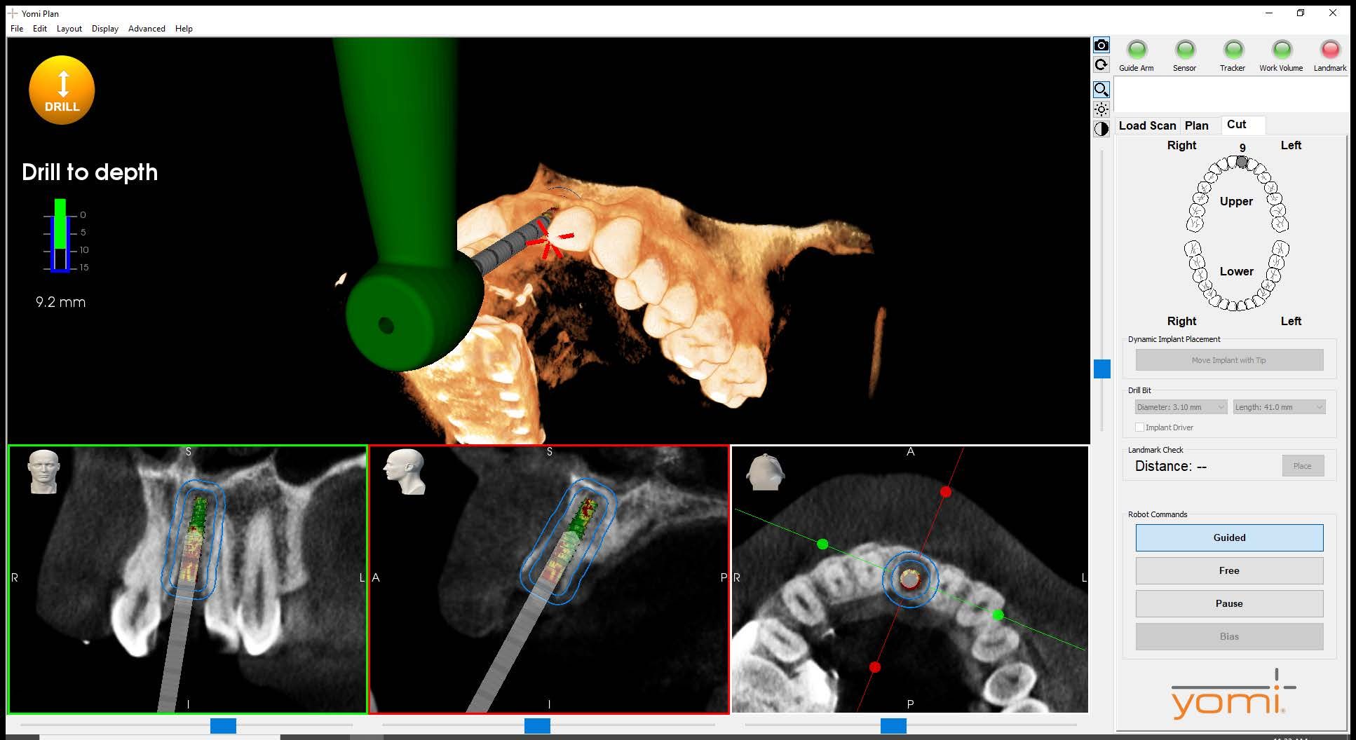 How to Achieve Accurate Implant Placement Using Robotic Guidance